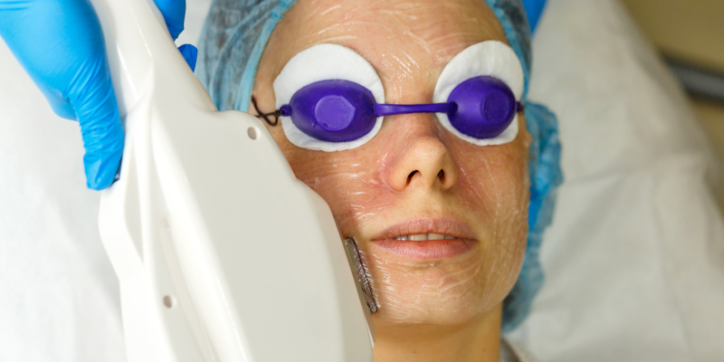 IPL Photofacial in Fort Myers, Florida